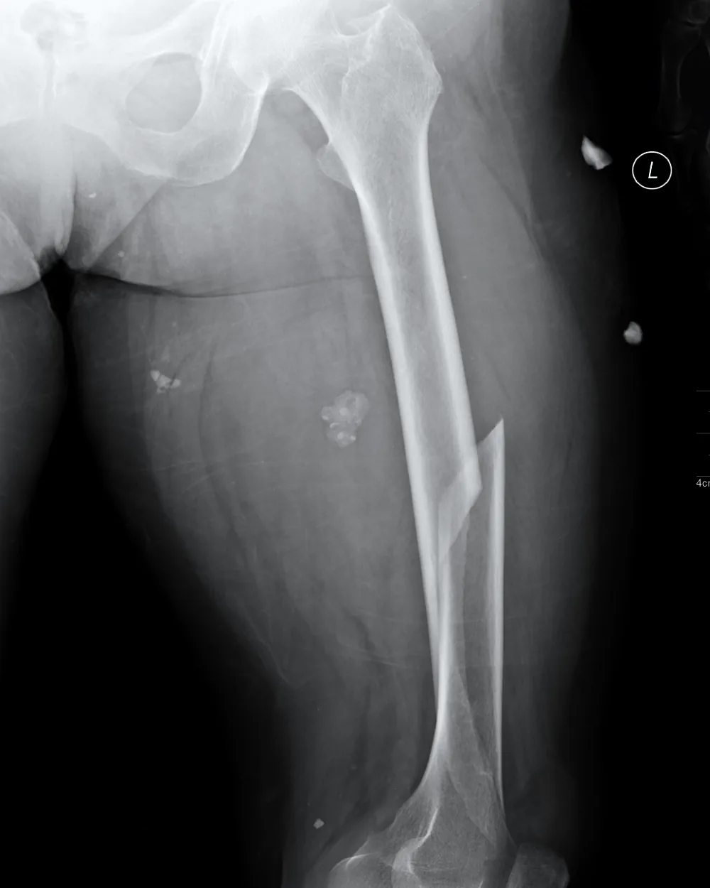 Radiograph of a femoral shaft fracture